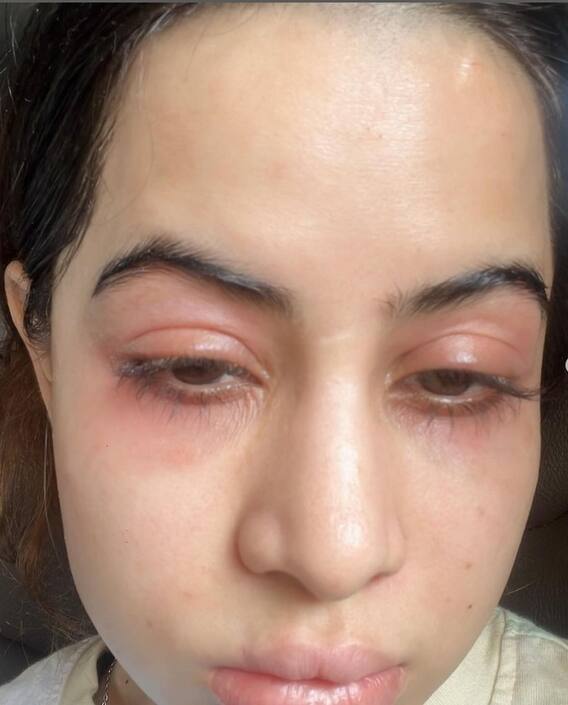 ਗਰਮੀ ਦੇ ਮੌਸਮ 'ਚ ਭਿਆਨਕ ਦਰਦ 'ਚੋਂ ਗੁਜ਼ਰ ਰਹੀ ਇਹ ਅਦਾਕਾਰਾ, ਸੁੱਜਿਆ ਚਿਹਰਾ