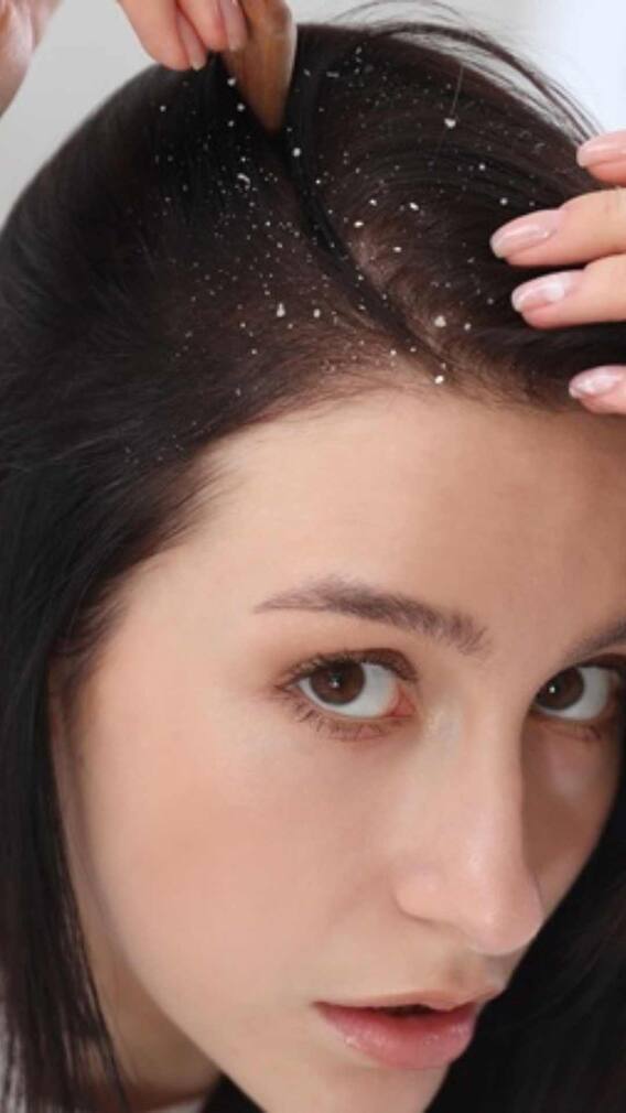 ਸਿਰ ਦੀ ਸਿੱਕਰੀ ਤੋਂ ਛੁਟਕਾਰਾ ਪਾਓ ਕੁਦਰਤੀ ਤਰੀਕਿਆਂ ਨਾਲ: ਚਮਕਦਾਰ ਤੇ ਸਾਫ਼ ਵਾਲਾਂ ਲਈ ਅਸਰਦਾਰ ਘਰੇਲੂ ਉਪਾਅ!