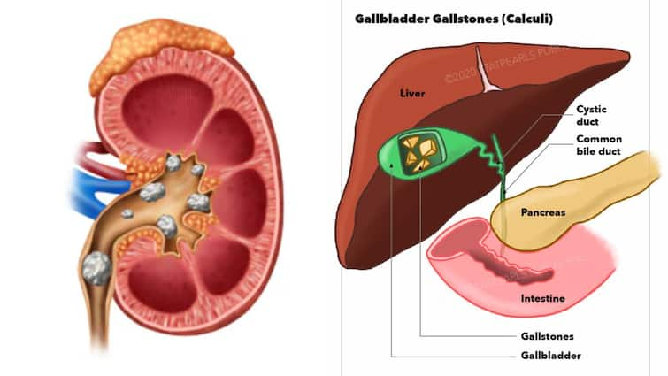 Kidney Stones Gallstones How One Can Differentiate Between Kidney Stones Gallstones Treatment Options