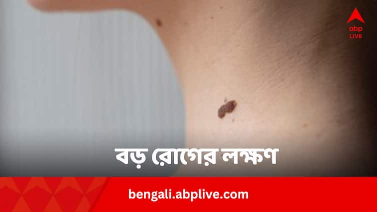 Health Tips Any Type Changes In Mole Can Be Skin Cancer Signs
