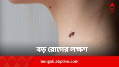 নিরীহ আঁচিলও মারাত্মক রোগের লক্ষণ ! কখন কীভাবে সতর্ক হবেন ?
