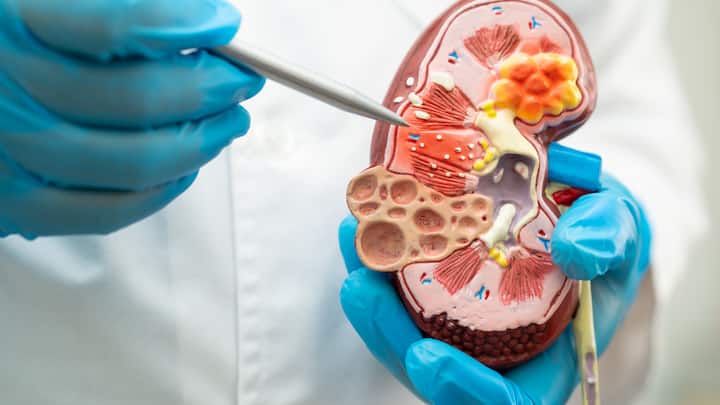 Kidney cancer presents a significant health challenge worldwide, including in India. Despite medical advancements, the often silent onset of kidney cancer complicates early detection and treatment.
