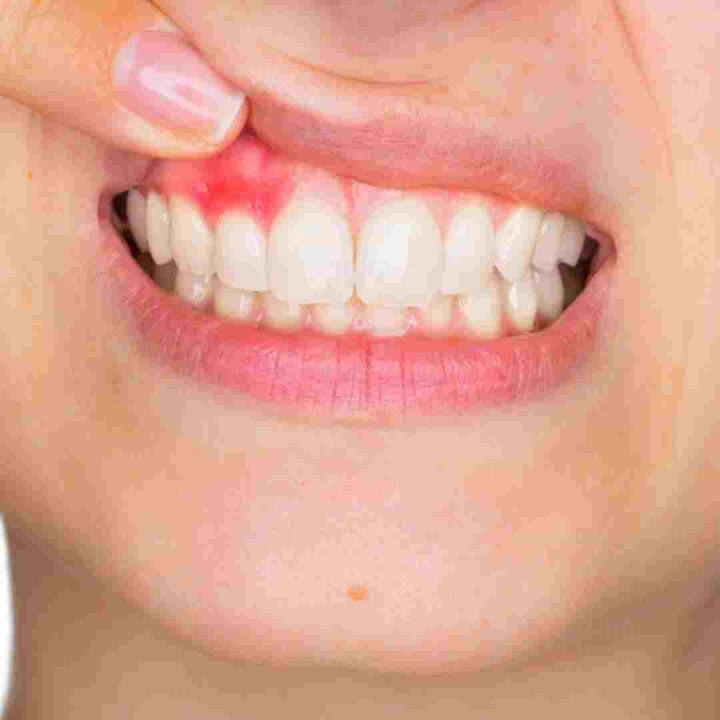 ਦੰਦਾਂ ਦੇ ਦਰਦ ਕਾਰਨ ਕਈ ਵਾਰ ਚਿਹਰੇ 'ਤੇ ਸੋਜ ਵੀ ਦਿਖਾਈ ਦਿੰਦੀ ਹੈ। ਖਾਸ ਕਰਕੇ ਬੱਚੇ ਦੰਦਾਂ ਦੇ ਦਰਦ ਤੋਂ ਬਹੁਤ ਪ੍ਰੇਸ਼ਾਨ ਹੁੰਦੇ ਹਨ, ਕਿਉਂਕਿ ਕਈ ਕਾਰਨ ਹਨ ਜਿਵੇਂ ਕਿ ਮਠਿਆਈਆਂ ਖਾਣੀਆਂ, ਬੁਰਸ਼ ਕਰਨ ਵਿੱਚ ਲਾਪਰਵਾਹੀ, ਬੱਚਿਆਂ ਦੇ ਦੰਦਾਂ ਵਿੱਚ ਕੈਵਿਟੀ ਹੋਣਾ ਇੱਕ ਆਮ ਸਮੱਸਿਆ ਹੈ, ਹਾਲਾਂਕਿ ਕਈ ਕਾਰਨਾਂ ਕਰਕੇ ਵੱਡਿਆਂ ਦੇ ਦੰਦਾਂ ਵਿੱਚ ਕੈਵਿਟੀ ਦੀ ਸਮੱਸਿਆ ਵੀ ਹੁੰਦੀ ਹੈ। ਲੱਗਦਾ ਹੈ।