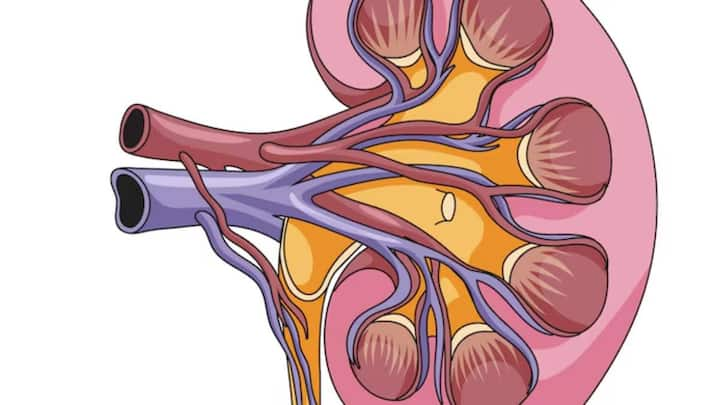 According to the National Institute of Health, kidney stones are caused by dehydration in the body.  In fact, when there is a lack of water in the body, there is a lack of diuresis in the body.  Due to this, stones begin to accumulate in the kidneys.