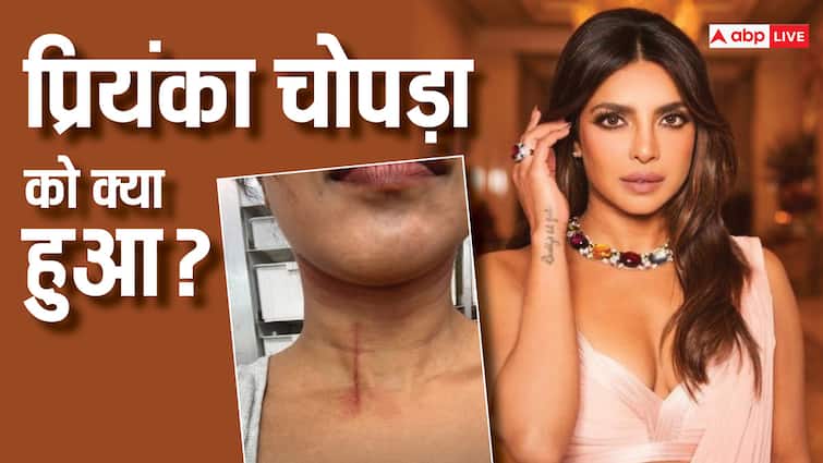 priyanka chopra injured during the bluff stunt shooting shared picture शूटिंग के दौरान घायल हुईं Priyanka Chopra, स्टंट करने में गर्दन पर लगी चोट, एक्ट्रेस ने शेयर की तस्वीर
