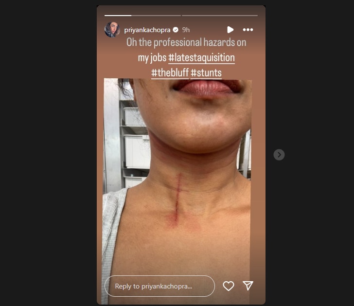 शूटिंग के दौरान घायल हुईं Priyanka Chopra, स्टंट करने में गर्दन पर लगी चोट, एक्ट्रेस ने शेयर की तस्वीर