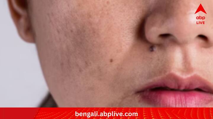 কখনও সখনও ত্বকের কিছু অংশ অন্য়ান্য জায়গার তুলনায় বেশি কালো হয়ে যায়। একে বলে হাইপারপিগমেনটেশন। চালকুমড়োর রস ত্বকের এই সমস্যা মোকাবিলাতেও কাজে দেয়।