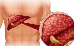 Health: ਫੈਟੀ ਲੀਵਰ ਹੋਣ ਤੋਂ ਪਹਿਲਾਂ ਸਰੀਰ 'ਚ ਨਜ਼ਰ ਆਉਂਦੇ ਆਹ ਲੱਛਣ, ਅਚਾਨਕ ਸਿਹਤ ਹੁੰਦੀ ਖਰਾਬ