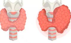 Thyroid Symptoms: ਥਾਇਰਾਇਡ ਵਧਣ ਤੋਂ ਪਹਿਲਾਂ ਸਰੀਰ 'ਚ ਹੁੰਦਾ ਖਤਰਨਾਕ ਬਦਲਾਅ, ਇਦਾਂ ਕਰ ਸਕਦੇ ਕੰਟਰੋਲ