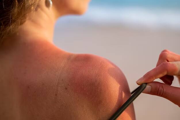 Increasing cases of sun poisoning in women Know the remedy and causes Sun Poisoning : વધુમાં વધુ મહિલાઓ બની રહી છે સન પોઇઝિંગનો શિકાર, જાણો લક્ષણો અને ઉપાય