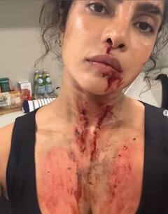 Priyanka Chopra: ਪ੍ਰਿਯੰਕਾ ਚੋਪੜਾ ਨੂੰ ਅਜਿਹੀ ਹਾਲਤ 'ਚ ਵੇਖ ਘਬਰਾਏ ਫੈਨਜ਼, ਗਰਦਨ ਸਣੇ ਸਰੀਰ 'ਤੇ ਹੋਏ ਡੂੰਘੇ ਜ਼ਖਮ