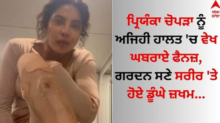 Priyanka Chopra Injury: ਗਲੋਬਲ ਅਦਾਕਾਰਾ ਪ੍ਰਿਯੰਕਾ ਚੋਪੜਾ ਆਏ ਦਿਨ ਸੋਸ਼ਲ ਮੀਡੀਆ ਉੱਪਰ ਚਰਚਾ ਦਾ ਵਿਸ਼ਾ ਬਣੀ ਰਹਿੰਦੀ ਹੈ।