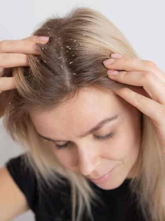 डैंड्रफ को कैसे रख सकते हैं दूर