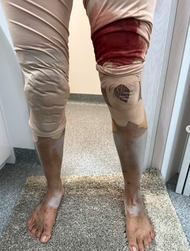 ਹਾਲ ਹੀ 'ਚ 'ਦਿ ਬਲਫ' ਦੀ ਸ਼ੂਟਿੰਗ ਦੌਰਾਨ ਪ੍ਰਿਯੰਕਾ ਦੀ ਗਰਦਨ 'ਤੇ ਡੂੰਘਾ ਜ਼ਖਮ ਹੋ ਗਿਆ ਸੀ ਅਤੇ ਹੁਣ ਉਸ ਦਾ ਵੀਡੀਓ ਸੁਰਖੀਆਂ 'ਚ ਰਿਹਾ, ਜਿਸ 'ਚ ਉਸ ਦੇ ਪੈਰਾਂ ਦੀ ਹਾਲਤ ਦੇਖ ਕੇ ਪ੍ਰਸ਼ੰਸਕ ਹੈਰਾਨ ਹਨ। ਜਦੋਂ ਵਿਦੇਸ਼ੀ ਧਰਤੀ 'ਤੇ 'ਦੇਸੀ ਗਰਲ' ਨੂੰ ਕੁਝ ਨਹੀਂ ਸੁੱਝਿਆ, ਤਾਂ ਅਭਿਨੇਤਰੀ ਨੇ ਇੱਕ ਘਰੇਲੂ ਨੁਸਖਾ ਅਪਣਾਈਆਂ।