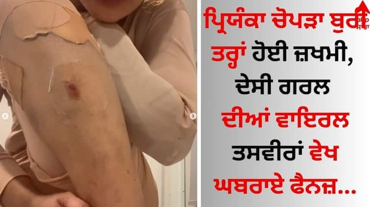 Priyanka Chopra was badly injured, fans were shocked to see the viral pictures of the desi girl Priyanka Chopra: ਪ੍ਰਿਯੰਕਾ ਚੋਪੜਾ ਬੁਰੀ ਤਰ੍ਹਾਂ ਹੋਈ ਜ਼ਖਮੀ, ਦੇਸੀ ਗਰਲ ਦੀਆਂ ਵਾਇਰਲ ਤਸਵੀਰਾਂ ਵੇਖ ਘਬਰਾਏ ਫੈਨਜ਼