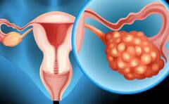 Health: ਸ਼ੂਗਰ ਨਾਲ ਵਧਦਾ ਓਵੇਰੀਅਨ ਕੈਂਸਰ ਦਾ ਖਤਰਾ, ਇਦਾਂ ਕਰੋ ਲੱਛਣਾਂ ਦੀ ਪਛਾਣ: ICMR