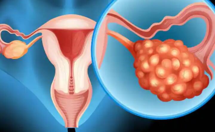 ਓਵੇਰੀਅਨ ਕੈਂਸਰ ਔਰਤਾਂ ਵਿੱਚ ਪਾਏ ਜਾਣ ਵਾਲੇ ਸਭ ਤੋਂ ਗੰਭੀਰ ਕੈਂਸਰਾਂ ਵਿੱਚੋਂ ਇੱਕ ਹੈ। ਕਿਉਂਕਿ ਇਸ ਦੇ ਸ਼ੁਰੂਆਤੀ ਲੱਛਣ ਸਰੀਰ 'ਤੇ ਨਜ਼ਰ ਨਹੀਂ ਆਉਂਦੇ ਹਨ। ਜਦੋਂ ਤੱਕ ਇਸ ਦੇ ਲੱਛਣ ਨਜ਼ਰ ਆਉਂਦੇ ਹਨ, ਉਦੋਂ ਤੱਕ ਇਗ ਗੰਭੀਰ ਰੂਪ ਲੈ ਲੈਂਦਾ ਹੈ। ਡਾਇਬਟੀਜ਼ ਓਵੇਰੀਅਨ ਕੈਂਸਰ ਦੇ ਖਤਰੇ ਨੂੰ ਵਧਾਉਂਦੀ ਹੈ। ਓਵੇਰੀਅਨ ਕੈਂਸਰ 78 ਵਿੱਚੋਂ 1 ਔਰਤ ਨੂੰ ਪ੍ਰਭਾਵਿਤ ਕਰਦਾ ਹੈ। ਜਿਨ੍ਹਾਂ ਵਿੱਚੋਂ ਅੱਧੀਆਂ 63 ਸਾਲ ਜਾਂ ਇਸ ਤੋਂ ਵੱਧ ਉਮਰ ਦੀਆਂ ਹੁੰਦੀਆਂ ਹਨ।