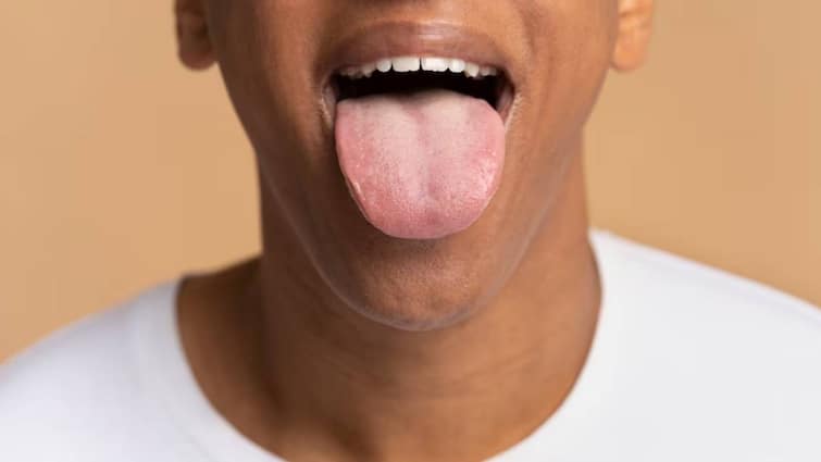 Can smoking cigarettes and drinking alcohol cause tongue cancer?