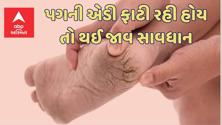 Lifestyle If the heel is tearing, there is definitely a disturbance in the liver understand the connection between the two Liver Disease: એડી ફાટી રહી હોય તો લીવરમાં ગડબડ હોવાનું પાક્કું, સમજી લો બંનેનું કનેકશન