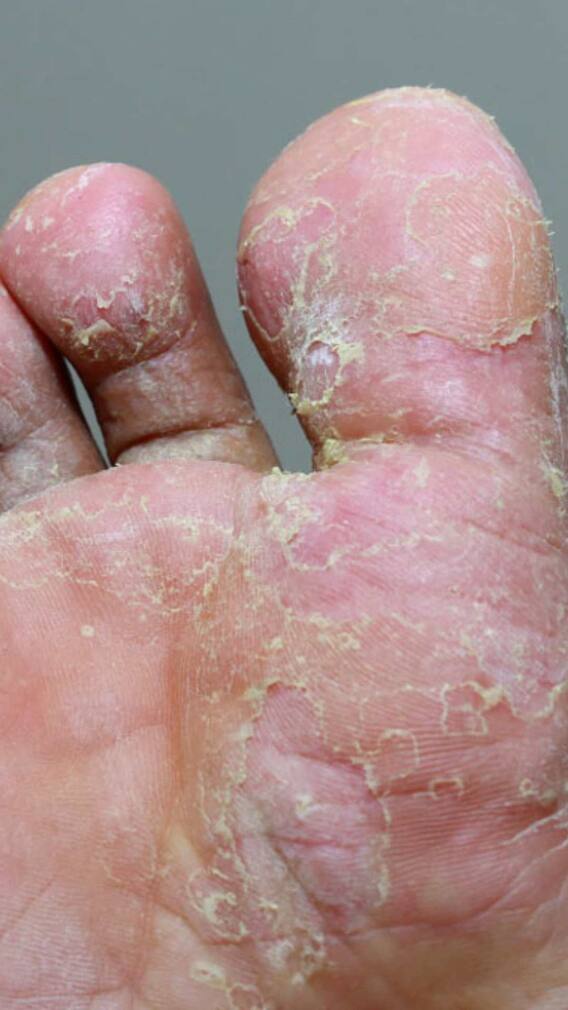 మీ పాదాల్లో ఈ మార్పులు కనిపిస్తున్నాయా? అయితే, షుగర్ పెరిగినట్లే!