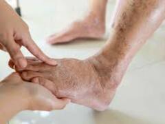 Diabetes: ਸਾਵਧਾਨ! ਬਾਰਿਸ਼ ਵਿੱਚ ਥੋੜ੍ਹੀ ਜਿਹੀ ਲਾਪਰਵਾਹੀ ਡਾਇਬਟੀਜ ਦੇ ਮਰੀਜ ਉੱਤੇ ਪੈ ਸਕਦੀ ਹੈ ਭਾਰੀ