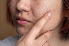 Pimples Problem: आपके चेहरे पर भी बार-बार होने लगते हैं पिंपल्स, हो सकते हैं ये पांच कारण