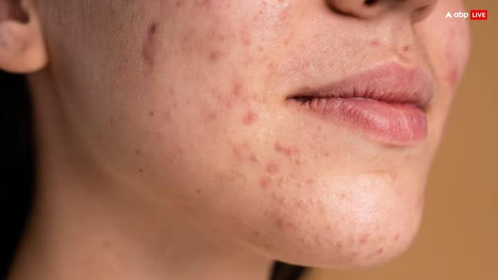 Pimples Problem: कई बार अचानक से चेहरे पर पिंपल्स होने लगते हैं, जिससे चेहरे की खूबसूरती कम हो जाती है. ऐसे में आज हम आपको पिंपल्स होने के कुछ कारण बताएंगे.