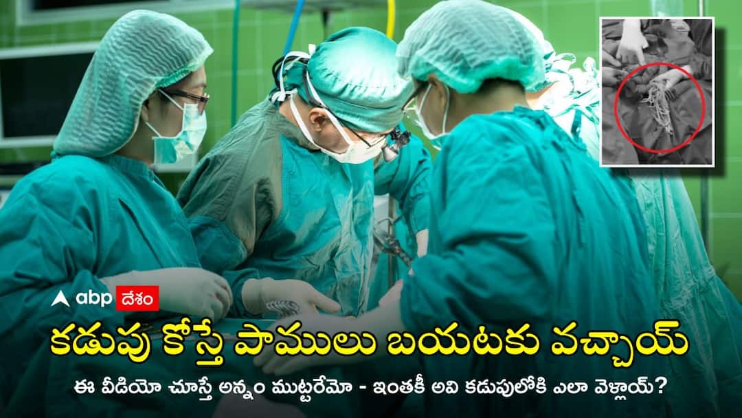 Worms in stomach: వామ్మో, అతడి కడుపు నిండా గుట్టల గుట్టలు పాములు - ఎలా బయటకు తీశారో చూడండి Doctors remove parasitic worms from human intestine in gut wrenching video goes viral Worms in stomach: వామ్మో, అతడి కడుపు నిండా గుట్టల గుట్టలు పాములు - ఎలా బయటకు తీశారో చూడండి