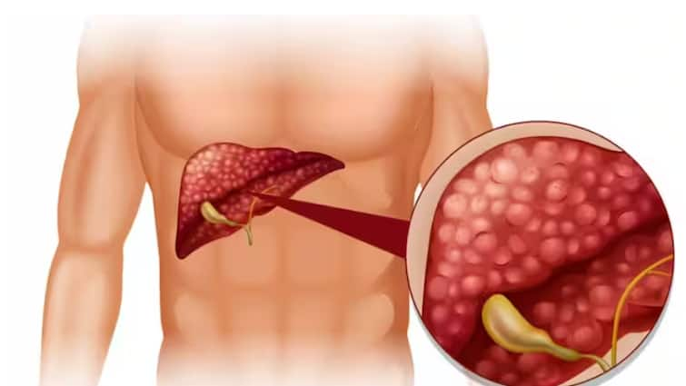 liver-swollen-hepatomegaly-symptoms-and-causes-of-an-enlarged-liver Health: ਲੀਵਰ 'ਚ ਸੋਜ ਆਉਣ 'ਤੇ ਸਰੀਰ 'ਚ ਨਜ਼ਰ ਆਉਂਦੇ ਆਹ ਲੱਛਣ, ਭੁੱਲ ਕੇ ਵੀ ਨਾ ਕਰੋ ਨਜ਼ਰਅੰਦਾਜ਼