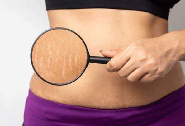 Home remedies to lighten stretch marks  Stretch Marks દૂર કરવા માંગતા હોય તો આ ઘરેલું ઉપાય કરો ટ્રાય