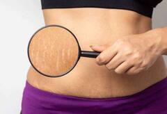 Stretch Marks દૂર કરવા માંગતા હોય તો આ ઘરેલું ઉપાય કરો ટ્રાય