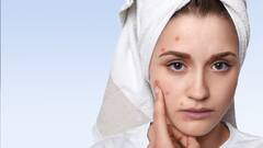Home Remedies For Acne-Prone Skin