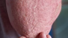 Epidermodysplasia Verruciformis: इस बीमारी में पेड़ जैसा बन जाता है इंसान, दुनिया में काफी कम केस