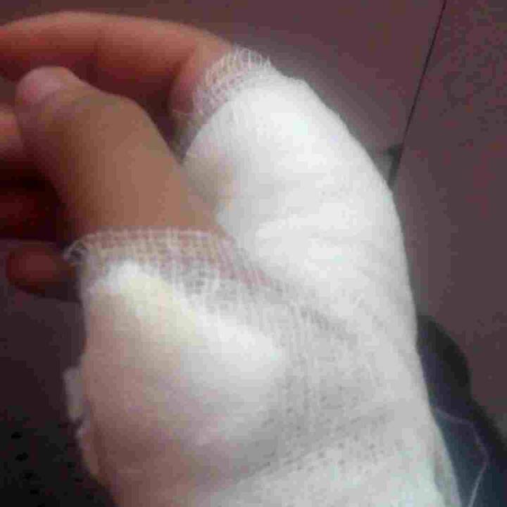 ਜੈਪੁਰ ਦੇ ਨਰਾਇਣ ਹਸਪਤਾਲ ਦੇ ਮੈਡੀਕਲ ਓਨਕੋਲੋਜੀ ਵਿਭਾਗ ਦੀ ਸਲਾਹਕਾਰ ਡਾ. ਪ੍ਰੀਤੀ ਅਗਰਵਾਲ ਦਾ ਕਹਿਣਾ ਹੈ ਕਿ ਮਾਮੂਲੀ ਕੱਟਾਂ ਜਾਂ ਸੱਟਾਂ 'ਤੇ ਪੱਟੀ ਦੀ ਵਾਰ-ਵਾਰ ਵਰਤੋਂ ਤੁਹਾਡੀ ਸਿਹਤ ਲਈ ਠੀਕ ਨਹੀਂ ਹੈ। ਹਾਲ ਹੀ ਵਿੱਚ ਹੋਈ ਇੱਕ ਖੋਜ ਅਨੁਸਾਰ ਸੱਟਾਂ ਲਈ ਵਰਤੀਆਂ ਜਾਣ ਵਾਲੀਆਂ ਪੱਟੀਆਂ ਕੈਂਸਰ ਵਰਗੀਆਂ ਘਾਤਕ ਬਿਮਾਰੀਆਂ ਦਾ ਕਾਰਨ ਬਣ ਸਕਦੀਆਂ ਹਨ।