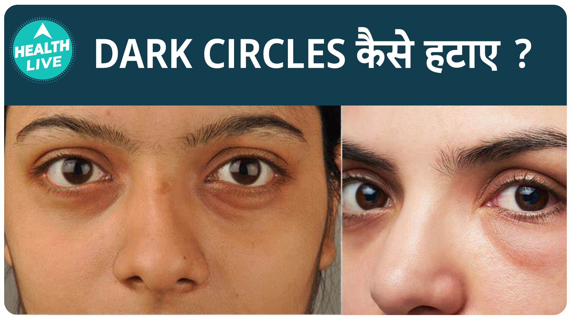 Follow These Home Remedies To Get Rid Of Dark Circles Naturally | Health Live