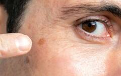 ચહેરા પરના દાગ દૂર કરવા માટે અપનાવો આ ઘરેલું ઉપાય, થશે ફાયદો