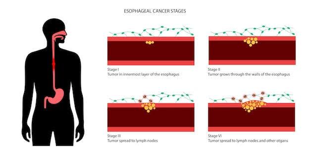 ग्रासनली का कैंसर: कैंसर जो फूड पाइप में होता है और जो खाने को गले से पेट तक ले जाती है, उसे ग्रासनली का कैंसर कहते हैं. ये ज्यादा शराब का सेवन, खासकर धूम्रपान के साथ करने से स्क्वैमस सेल कार्सिनोमा के खतरे को काफी हद तक बढ़ा देता है.