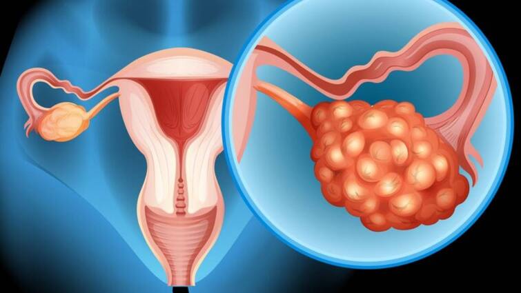 Symptoms of ovarian cancer are not visible at first