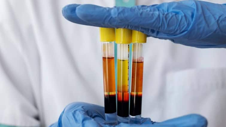 Blood in urine that can be seen with the naked eye may be a sign of advanced kidney disease पेशाब में खून आए तो समझ लें इस बीमारी की चपेट में आ गए हैं आप, तुरंत करें ये काम