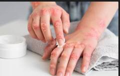 Monsoon Skincare: ਮਾਨਸੂਨ ਦੌਰਾਨ ਸਕਿਨ ਨੂੰ ਫੰਗਲ ਇਨਫੈਕਸ਼ਨ ਸਣੇ ਘੇਰਦੀਆਂ ਇਹ ਬਿਮਾਰੀਆਂ, ਇੰਝ ਕਰੋ ਬਚਾਅ