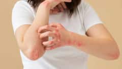 Monsoon Skincare: मॉनसून में आपकी स्किन पर होने लगते हैं फंगल इंफेक्शन या खुजली तो ये ट्रिक्स आजमाएं