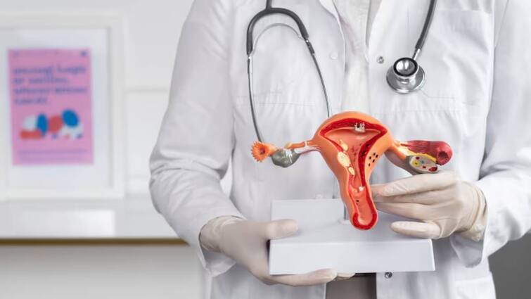 ovarian cysts symptoms and what is the types read full details ओवेरियन सिस्ट के शुरुआती लक्षण क्या हैं? साथ ही जानें यह कितने टाइप के होते हैं...इससे कैसे बचा जा सकता है?