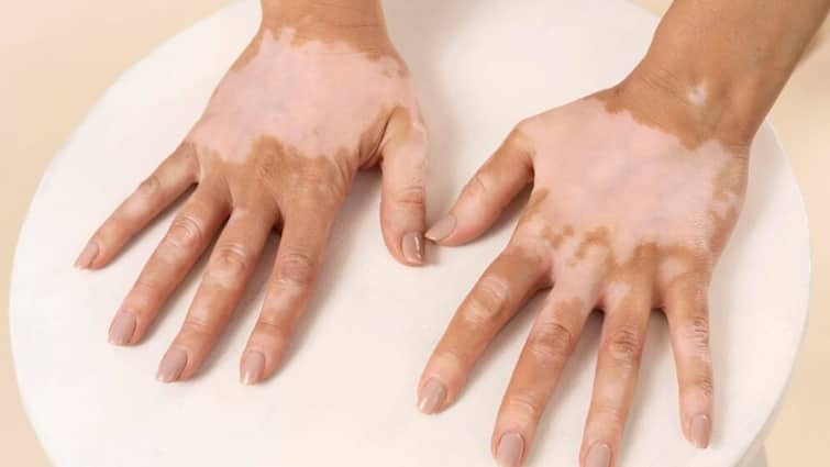 Do you know what vitiligo is and how this disease appears?