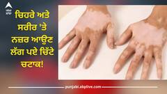 Vitiligo Disease: ਚਿਹਰੇ ਅਤੇ ਸਰੀਰ 'ਤੇ ਨਜ਼ਰ ਆਉਣ ਲੱਗ ਪਏ ਚਿੱਟੇ ਚਟਾਕ! ਜਾਣੋ ਕੀ ਹੈ ਵਿਟਿਲਿਗੋ ਅਤੇ ਕਿਵੇਂ ਹੁੰਦੀ ਇਹ ਬਿਮਾਰੀ?