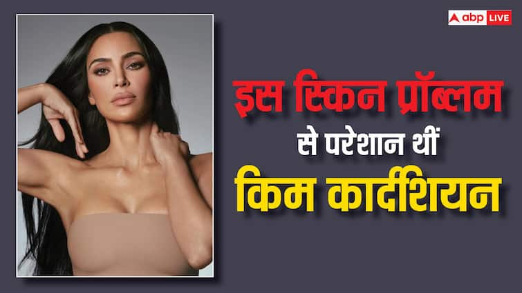 सोरायसिस से परेशान थीं किम कार्दशियन, जानें ये कितनी खतरनाक?