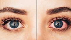 ਬੱਚੇ ਵੀ ਹੋ ਰਹੇ ਹਨ ਅੱਖਾਂ ਦੀ ਇਸ ਬਿਮਾਰੀ ਦਾ ਸ਼ਿਕਾਰ, ਗੌਰ ਨਾ ਕਰਨ 'ਤੇ ਜਾ ਸਕਦੀ ਹੈ ਰੋਸ਼ਨੀ...