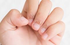 Dehydration: ડિહાઇડ્રેશનના કારણે થઈ શકે છે ચહેરા સાથે જોડાયેલી આ સમસ્યા, આ રીતે કરો બચાવ