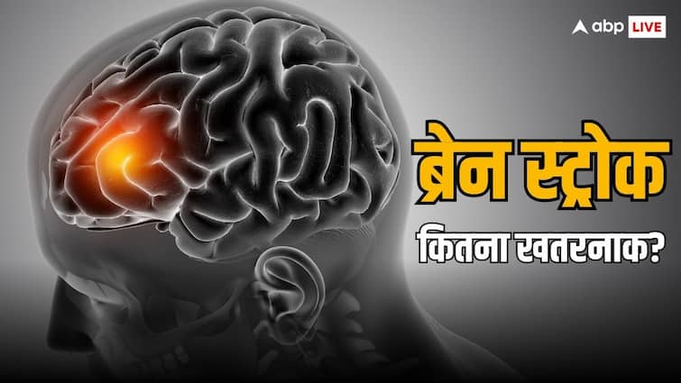 How many types of brain stroke are there? Know all about them from a neurologist