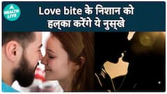 Health Tip: How to Remove Love Bite Mark Instantly at Home? Watch Top Remedies | Health LIVE