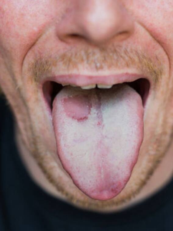 गुटखा खाने से कौन सा कैंसर होता है